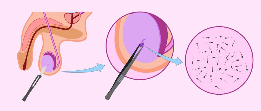 biopsie testiculaire 